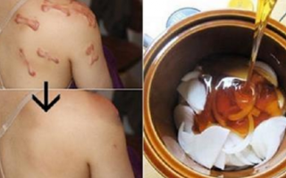 Những vết sẹo bỏng, sẹo lồi sẽ ngày một mờ dần và biến mất nhờ chăm chỉ làm việc này mỗi tối.