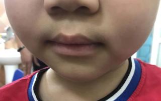 Lạm dụng thuốc xịt mũi khiến trẻ suy tuyến thượng thận