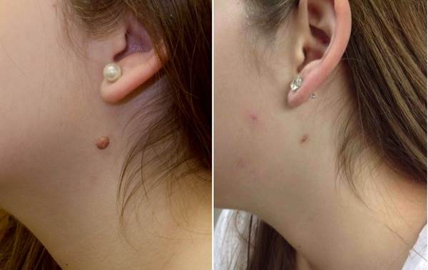 Cách đánh bay mụn thịt, mụn cóc trong vòng một nốt nhạc